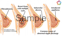 Abnormal Nipple Discharge Sample