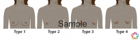 Breast Shapes Sample