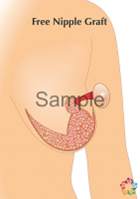 Free Nipple Graft Sample