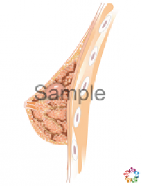 Galactocele Sample