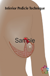 Inferior Pedicle Technique Sample