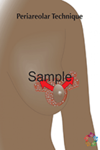 Periareolar Reduction Sample