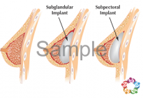 Sites For Implants Interior Sample