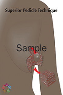 Superior Pedicle Reduction Sample